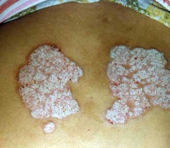 福州皮肤科医院哪家好_福州治疗牛皮癣好的医院