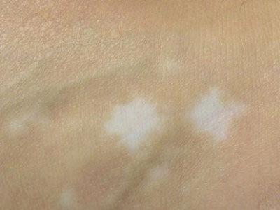 福州白癜风白斑的治疗较好医院是哪家_如何早日祛白