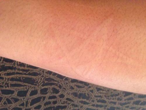 治荨麻疹福州哪个医院的皮肤科好啊