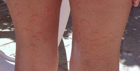 ���ݻ���ҽԺƤ���ƣ�ݡ��������Ʒ�������Щ