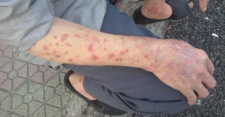 ���ݻ���ҽԺƤ���ƣ�����ǲ���ţƤѢ�ķ�������Щ