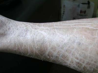 �����۲������Ǹ�Ƥ����ҽԺ��_���۲���Σ��