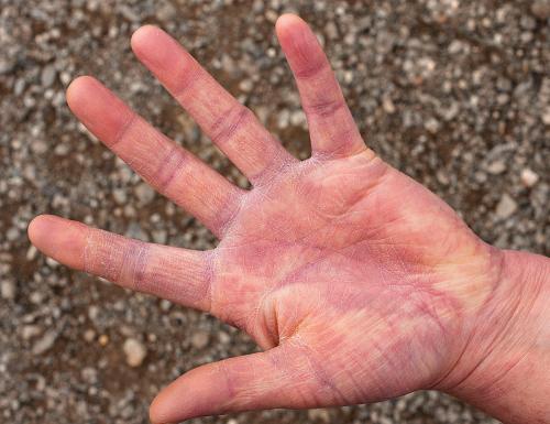 福州华研皮肤科医生:什么是多形红斑